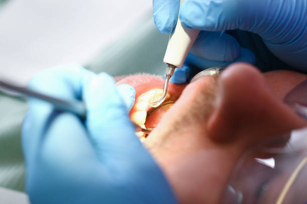 Best Emergency Tooth Extraction in Harvey, IL